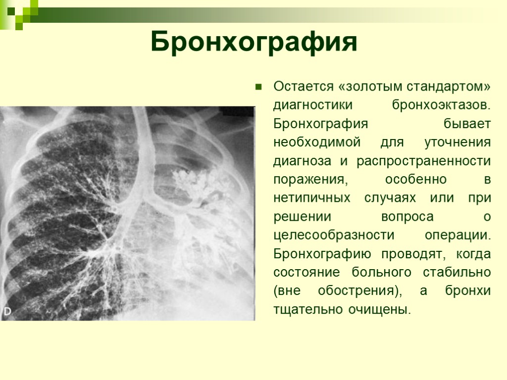 Бронхография Остается «золотым стандартом» диагностики бронхоэктазов. Бронхография бывает необходимой для уточнения диагноза и распространенности